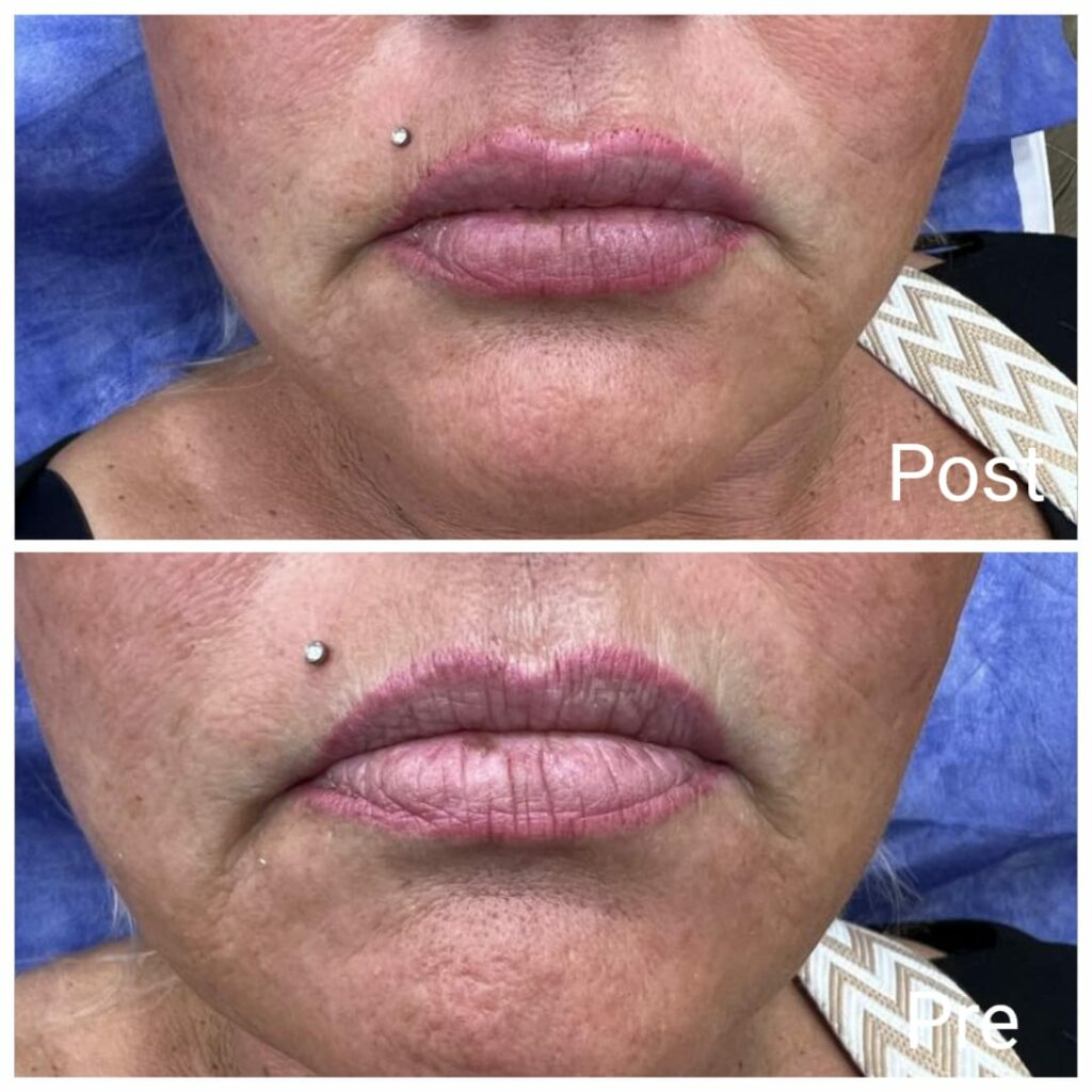 Lip filler doctors in Hurghada